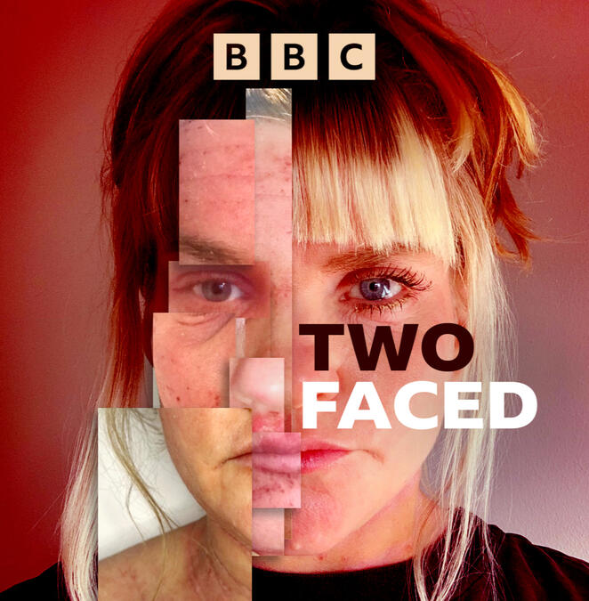 An image of 5 tubes of steroid creams. They are all crumbled and used. One is missing the lid. There is a pharmacy label in the corner of the photo which reads 'Two Faced'